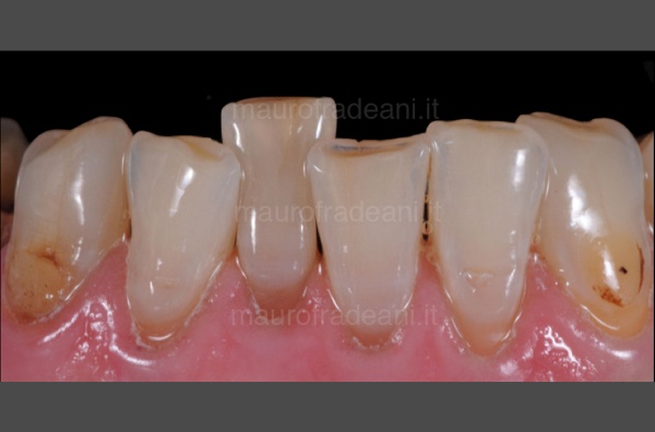 pre-prosthetic-orthodontics-clinical-case-dr-mauro-fradeani