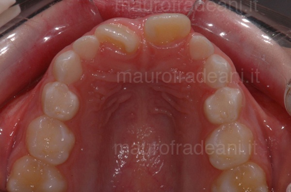 Clinical case of early orthodontics malocclusion and crowding Dr. Fradeani