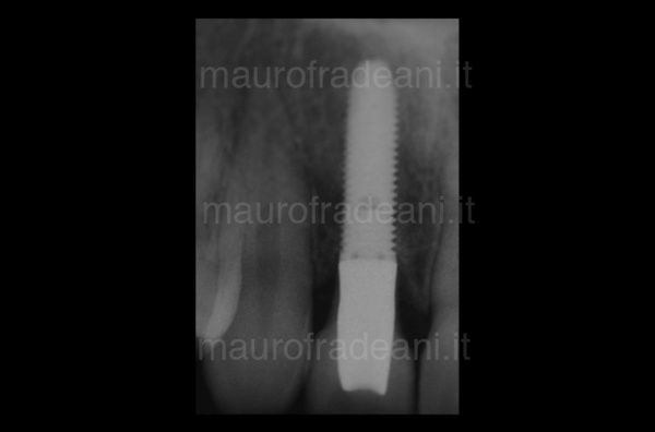 Dental implant in the anterior sector Dr. Fradeani