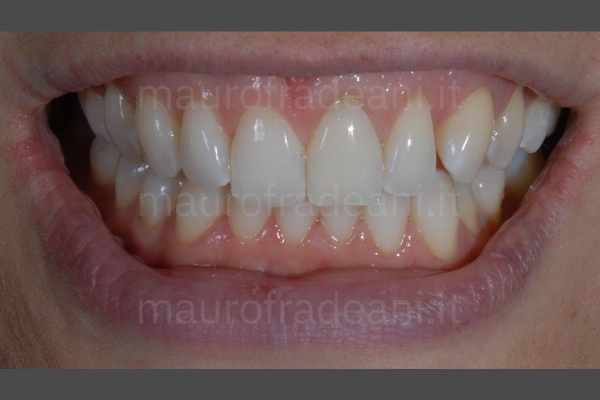 foto-post-trattamento-sbiancamento-dei-denti-