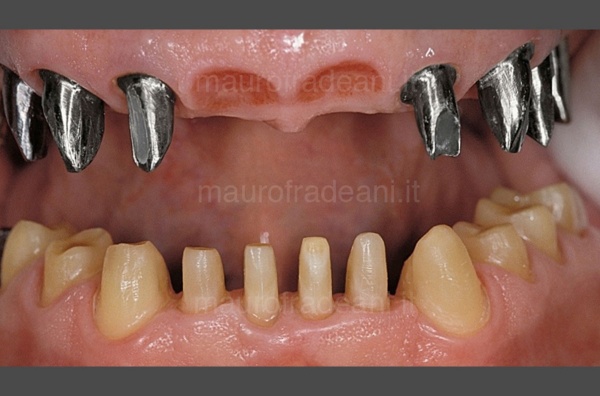 aesthetic-functional-rehabilitation-implants-clinical-case-dr-mauro-fradeani