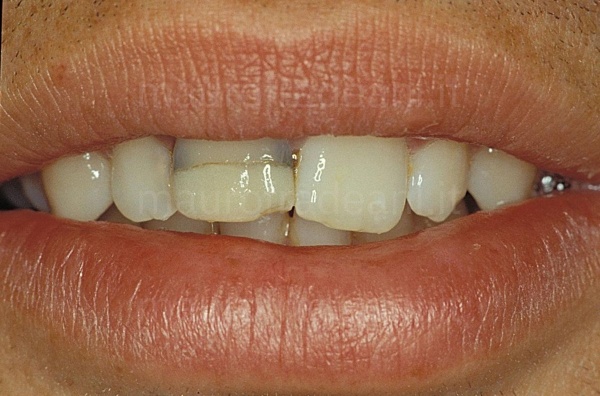 Clinical case ceramic crown on an anterior tooth already treated