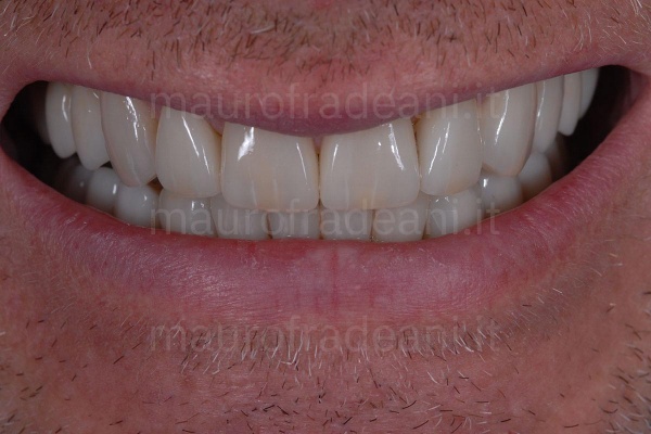 foto-dopo-trattamento-con-faccette-dentali-ultrasottili