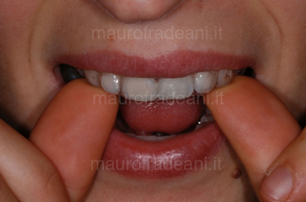 Clinical case of home dental whitening Dr. Fradeani