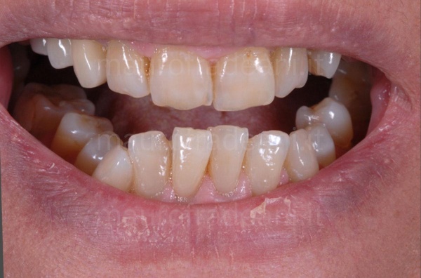 dental-braces-before-and-after-fradeani-specialised-dental-and-orthodontic-centre