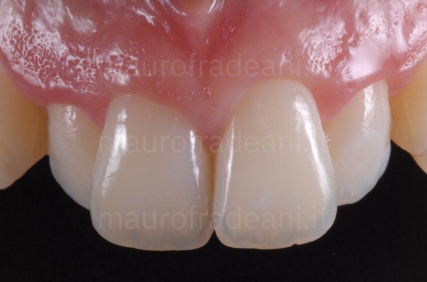 Clinical case of dental veneers in ceramic antero-superior sector misaligned Dr. Fradeani