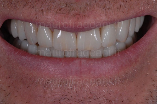 Dr. Fradeani ceramic veneers for excessive spaces between the teeth 