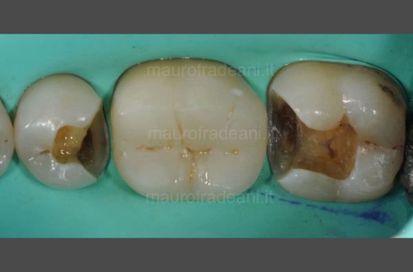 13-caso-clinico-odontoiatria-conservativa-dott-mauro-fradeani-trattamento