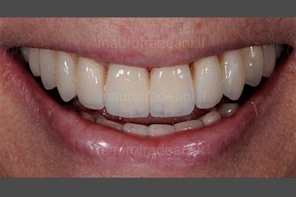 foto-post-intervento-chirurgia-orale-fradeani