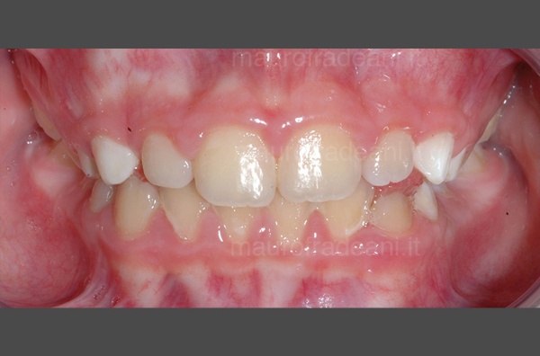 Early orthodontics clinical case Fradeani Dental Clinic