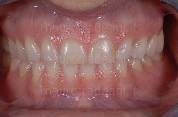 Clinical case aesthetic-functional rehabilitation for marked and widespread dental wear Dr. Fradeani