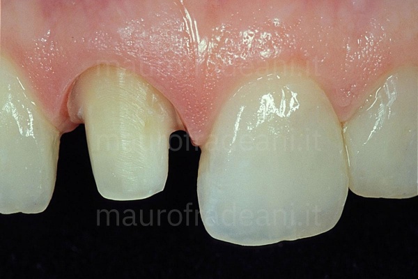 foto-pre-trattamento-con-capsule-dentali
