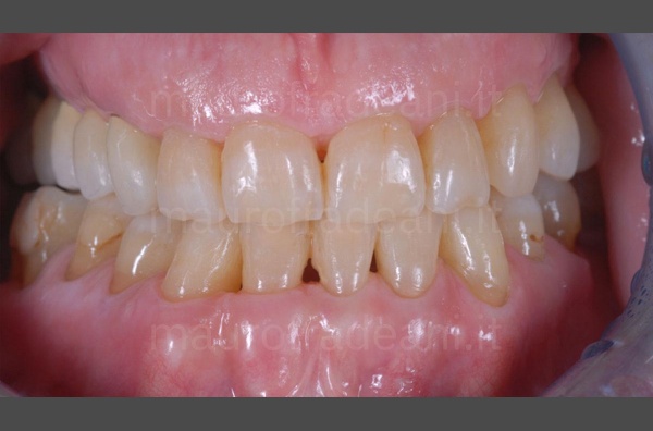 dental-braces-in-adult-patient-clinical-case-fradeani-dental-centre