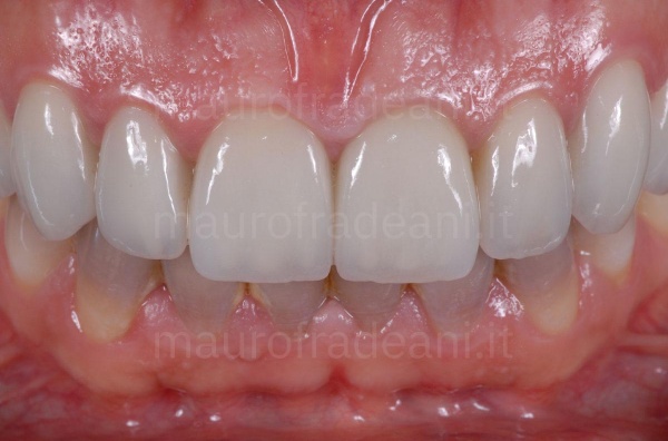 dental-veneers-on-a-patient-with-dyschromia-clinical-case-dr-mauro-fradeani