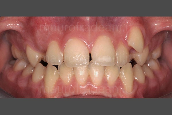 foto-pre-trattamento-ortodonzia-estetica