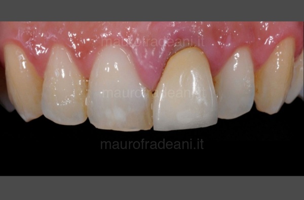 Ceramic crown on anterior tooth implant clinical case Dr. Mauro Fradeani