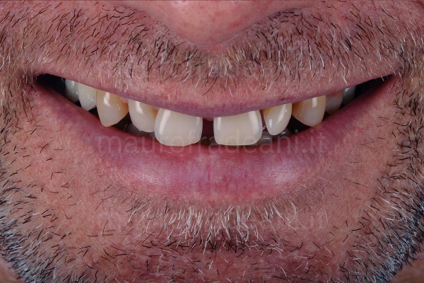 foto-prima-del-trattamento-con-faccette-estetiche-in-ceramica