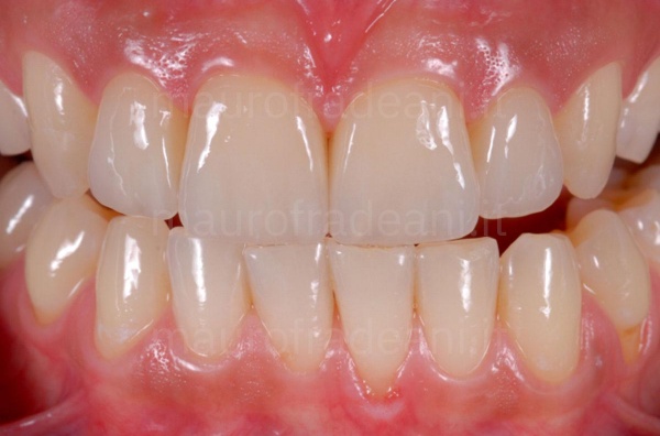 Dr. Mauro Fradeani ceramic dental veneers for marked dental wear 