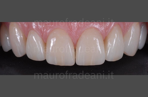 Ceramic veneers for excessive spaces between the teeth Dr. Fradeani