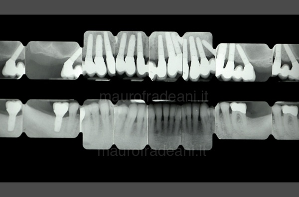 full-aesthetic-treatment-on-implants-clinical-case-fradeani-dental-clinic