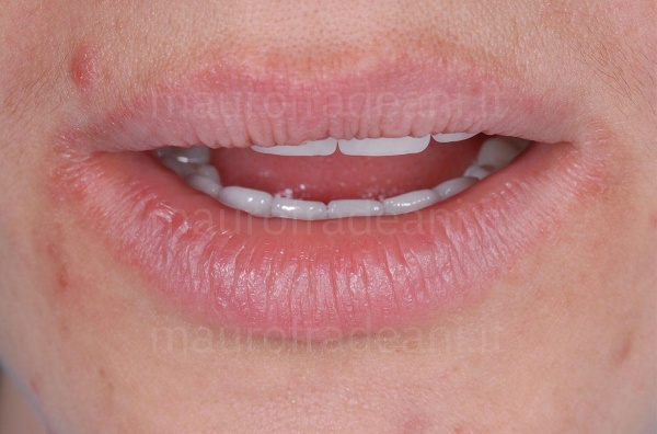 Dott. Fradeani riabilitazione estetico-funzionale per marcata e diffusa usura dentale 