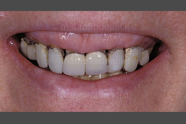 foto-prima-del-trattamento-con-impianto-dentale-chirurgico