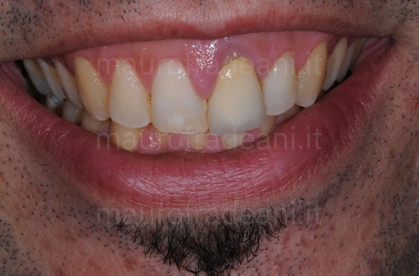 Ceramic crown on anterior tooth implant clinical case