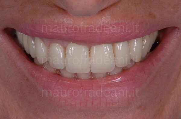 Fradeani Dental Clinic ceramic crowns on implants clinical case 