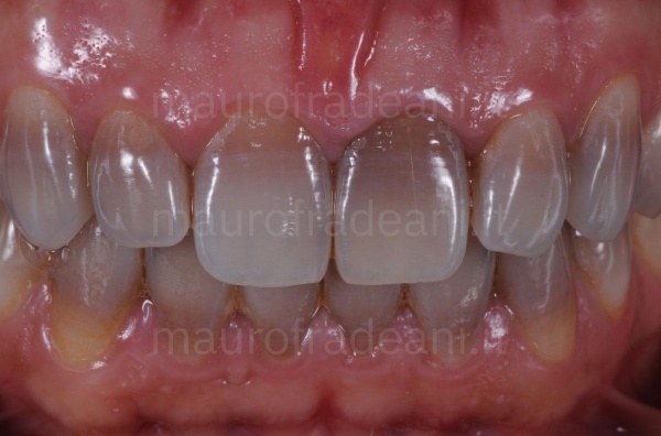 dental-veneers-full-set-on-a-patient-with-dyschromia-clinical-case-dr-mauro-fradeani