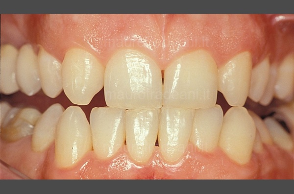 Clinical case of professional oral hygiene Dr. Fradeani