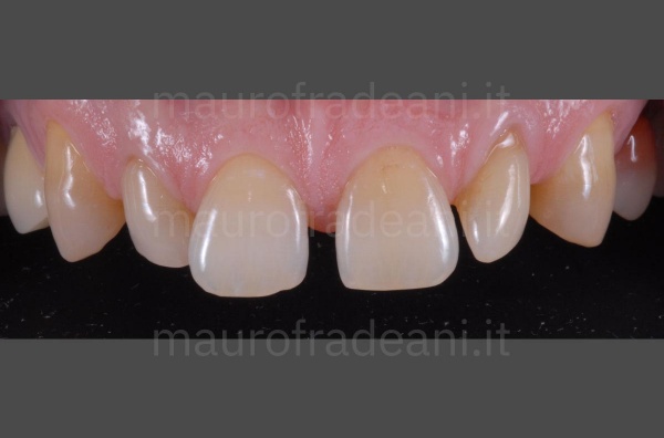 Ceramic veneers for excessive spaces between the teeth clinical case Dr. Fradeani