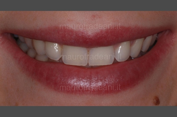 Clinical case of home dental whitening with aligners