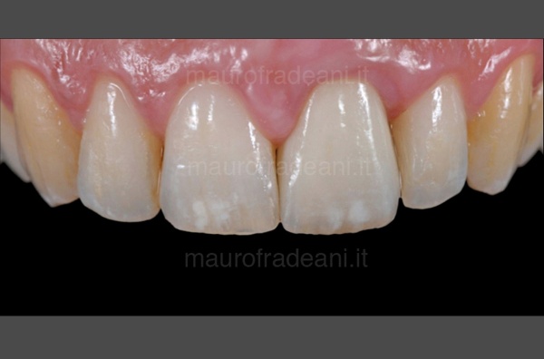 Fradeani Dental Clinic ceramic crown on anterior tooth implant