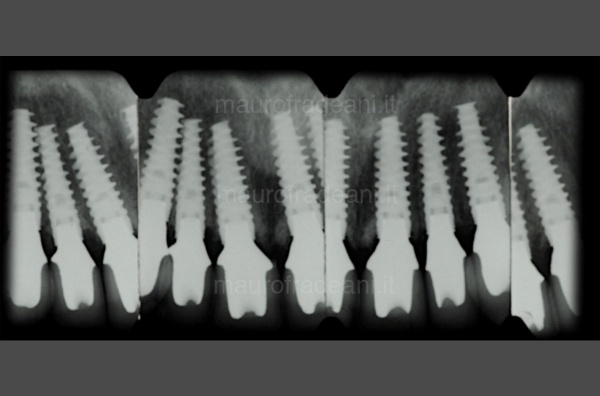 Ceramic crowns on implants Dr. Mauro Fradeani