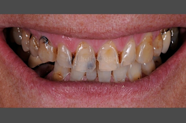 Clinical case aesthetic-functional rehabilitation for severe dental compromise