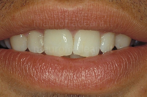 Dr. Mauro Fradeani ceramic crown on an anterior tooth already treated clinical case