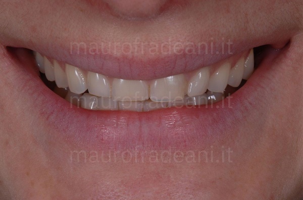 Caso clinico riabilitazione estetico-funzionale per marcata e diffusa usura dentale