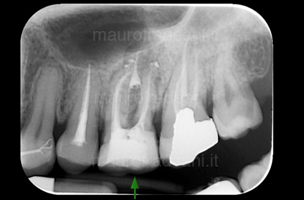 Retreatment of an already devitalized tooth Dr. Mauro Fradeani