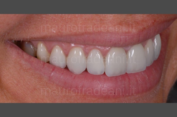 ceramic-veneers-for-discolouring-teeth-clinical-case