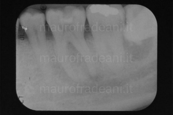 foto-endodonzia-chirurgica-prima-del-trattamento