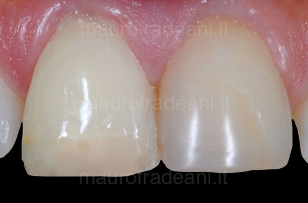 Dr. Mauro Fradeani clinical case whitening in the devitalized tooth clinic 