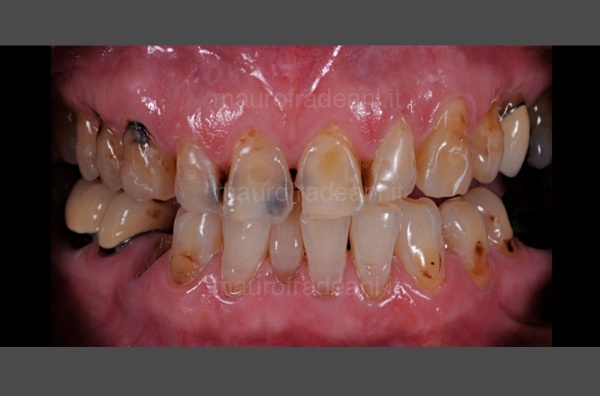 Clinical case aesthetic-functional rehabilitation for severe dental compromise Dr. Fradeani