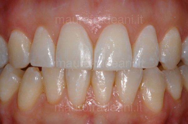 Dr. Mauro Fradeani clinical case of dental whitening 