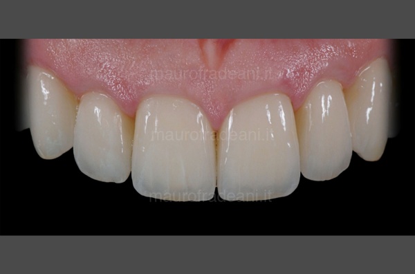 Ceramic crowns on implants clinical case Fradeani Dental Clinic