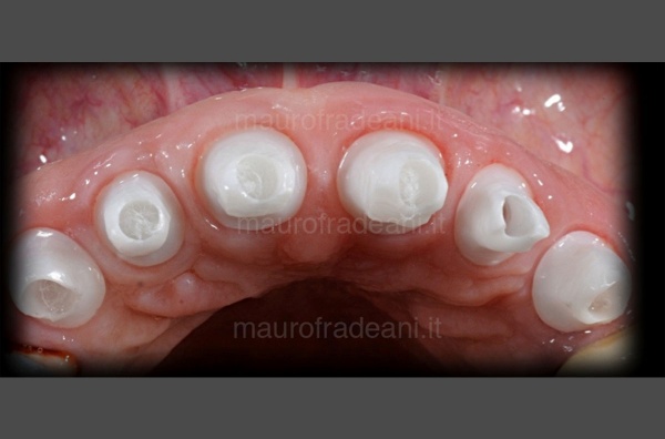 Dr. Mauro Fradeani ceramic crowns on implants