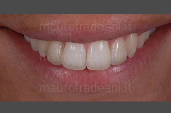 Dr. Fradeani dental veneers in ceramic antero-superior sector misaligned