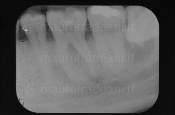 Clinical case root canal treatment of vital tooth Dr. Mauro Fradeani