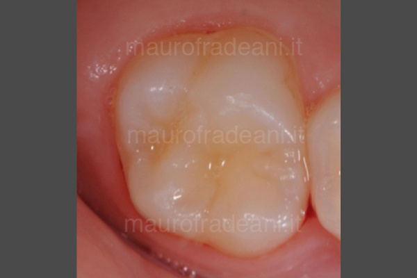 foto-odontoiatria-pediatrica-prima-del-trattamento