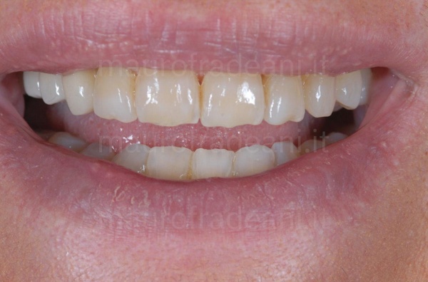 dental-braces-clinical-case-before-and-after-fradeani-specialised-dental-and-orthodontic-centre